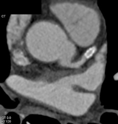 Patent Stent in LAD - CTisus CT Scan