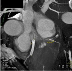 Patent Stent in LAD - CTisus CT Scan