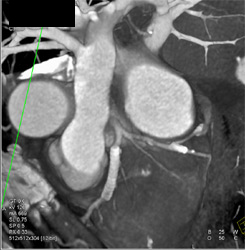 Patent Stent in LAD - CTisus CT Scan