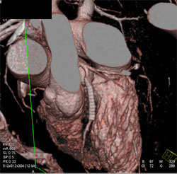 Patent Stent in LAD - CTisus CT Scan