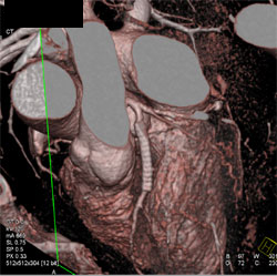 Patent Stent in LAD - CTisus CT Scan