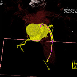 Patent Stent in LAD - CTisus CT Scan