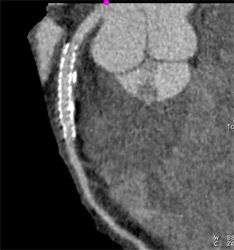 Patent Stent in LAD - CTisus CT Scan