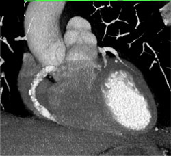 Diseased But Patent RCA - CTisus CT Scan