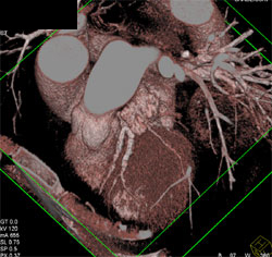 Diseased LAD - CTisus CT Scan