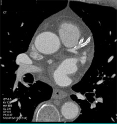 Diseased LAD - CTisus CT Scan