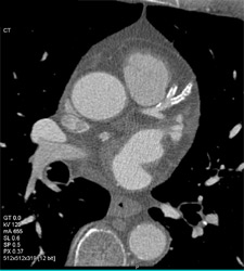 Diseased LAD - CTisus CT Scan