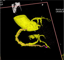 Diseased RCA - CTisus CT Scan