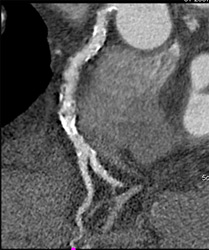 Diseased RCA - CTisus CT Scan