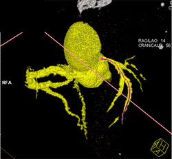 Patent LAD Stent - CTisus CT Scan