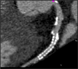 Patent LAD Stent - CTisus CT Scan