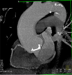 Aortic Valve Replacement (AVR)- See Video File for Nice 4D - CTisus CT Scan