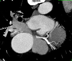 LAD Plaque - CTisus CT Scan