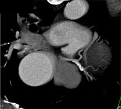 LAD Plaque - CTisus CT Scan