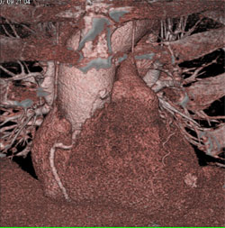 Diseased LAD - CTisus CT Scan