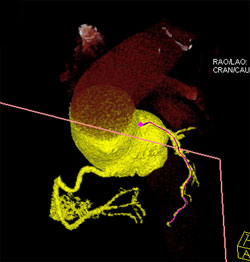 Diseased LAD - CTisus CT Scan