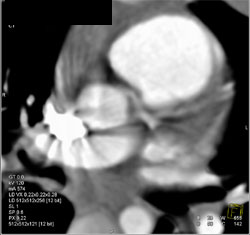 Dilated Pulmonary Outflow Tract - CTisus CT Scan