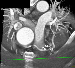 Pseudolesion in Bypass Graft Due to Cutoff of Top of Graft-area Not Scanned - CTisus CT Scan