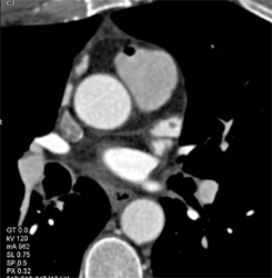 Air in Pulmonary Artery- Be Careful - CTisus CT Scan