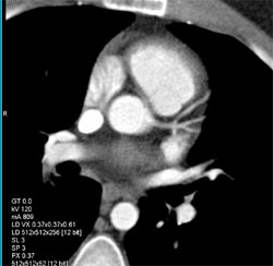 Nice Ramus Intermedius - CTisus CT Scan