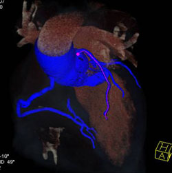 Normal LAD - CTisus CT Scan