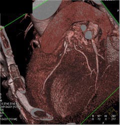 LAD and Circumflex Arise Adjacent to Each Other From Left Cusp - CTisus CT Scan