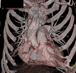 Bypass Graft Evaluation - CTisus CT Scan