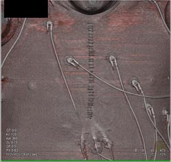 Post Medial Sternotomy Changes - CTisus CT Scan