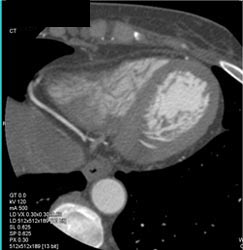 Normal Circulation - CTisus CT Scan