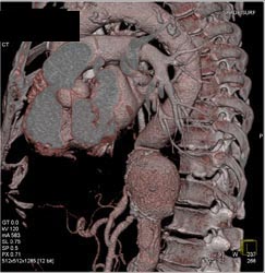 Aneurysm Off Lower Thoracic Aorta - CTisus CT Scan