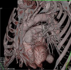 Bypass Grafts - CTisus CT Scan