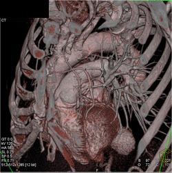 Bypass Grafts - CTisus CT Scan