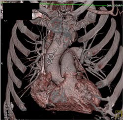 Bypass Grafts - CTisus CT Scan