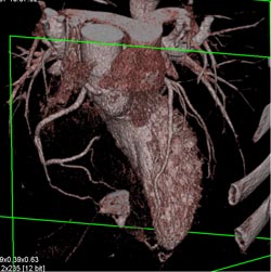 Normal RCA - CTisus CT Scan