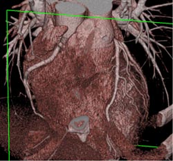 Normal RCA - CTisus CT Scan