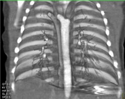 Double Aortic Arch Compresses Airway - CTisus CT Scan