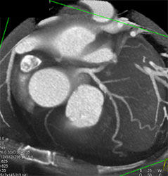 Minimal Plaques LAD - CTisus CT Scan