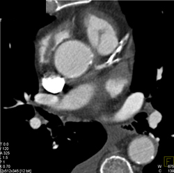 Extensive Plaque LAD With Greater Than 50% Stenosis - CTisus CT Scan