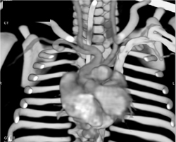 Congenital Heart Disease - CTisus CT Scan