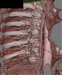 Intercostal Vessels - CTisus CT Scan