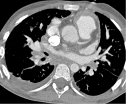 Post Chd Repair With Pulmonary Artery Stenosis - CTisus CT Scan