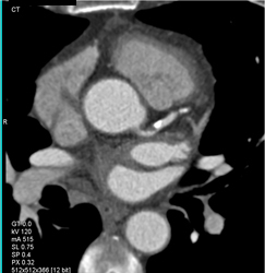 LAD With Calcified and Soft Plaque With Greater Than 50% Stenosis - CTisus CT Scan