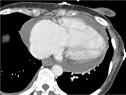 Pericardial Effusion - CTisus CT Scan