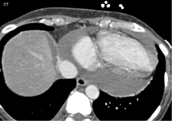 Pericardial Effusion - CTisus CT Scan