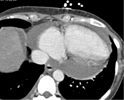 Pericardial Effusion - CTisus CT Scan