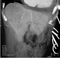 Reflux Into IVC and Hepatic Veins Due to Poor Cardiac Function - CTisus CT Scan