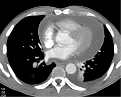 Pericardial Effusion - CTisus CT Scan