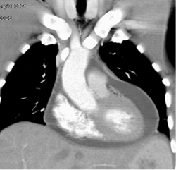 Pericardial Effusion - CTisus CT Scan