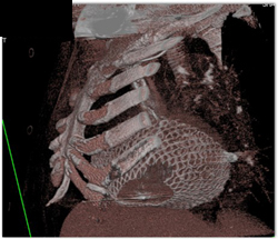 Mesh Around Heart to Improve Contractility - CTisus CT Scan