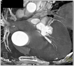 Stent in LAD - CTisus CT Scan